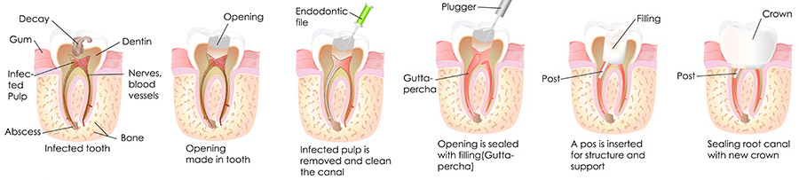 Phoenix family dentist | root canals | Dr. Jakobsen